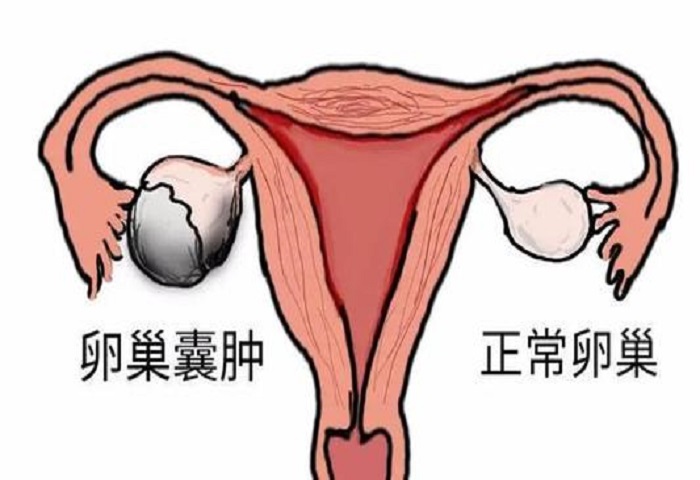 卵巢囊肿的症状表现