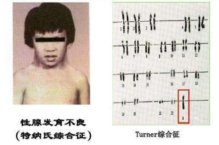 特纳综合征表现有真人图片吗