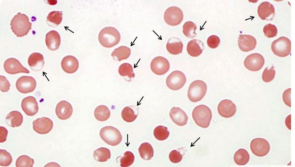 2,先天性非球形红细胞性溶血性贫血;3,新生儿高胆红素血症;4,蚕豆病
