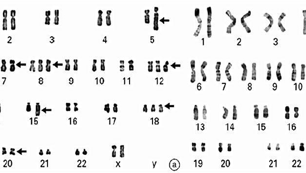 性染色体嵌合体图片