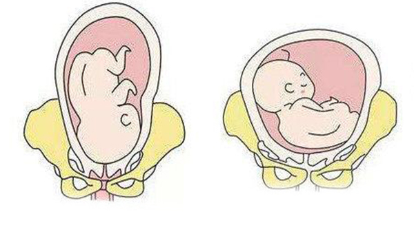 胎儿rot胎位示意图图片