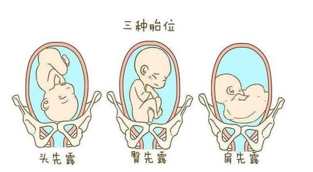 右骶前胎位图图片