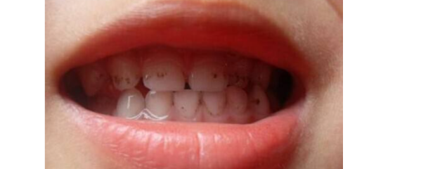 8岁儿童牙齿发黑洗牙能变白吗?