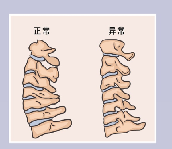 颈椎的生理弯曲