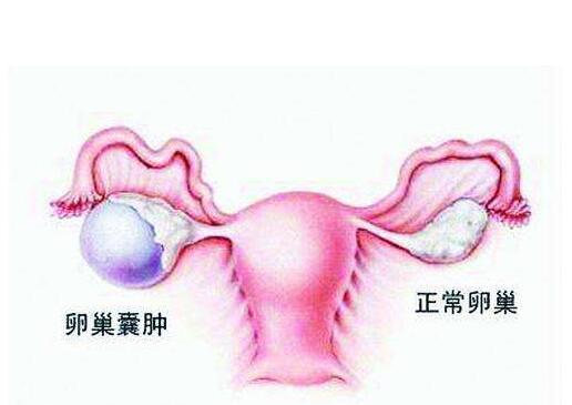 卵巢囊肿图片位置图片