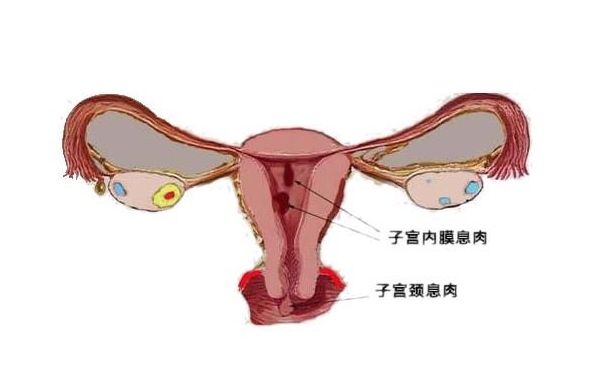 宫颈息肉示意图图片