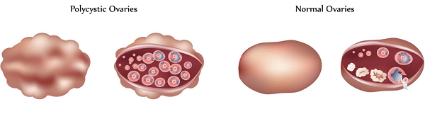 多囊卵巢可以做试管吗？试管费用是多少？